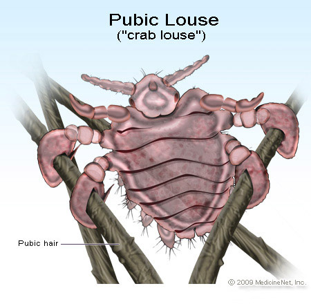Pubic louse