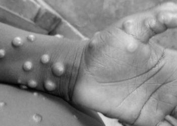 WHO okays 3 Ugandan labs,  donates monkeypox test kits
