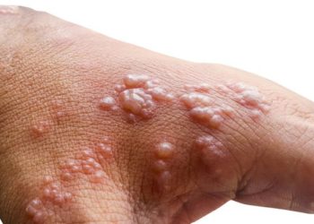 Government intensifies monkeypox surveillance